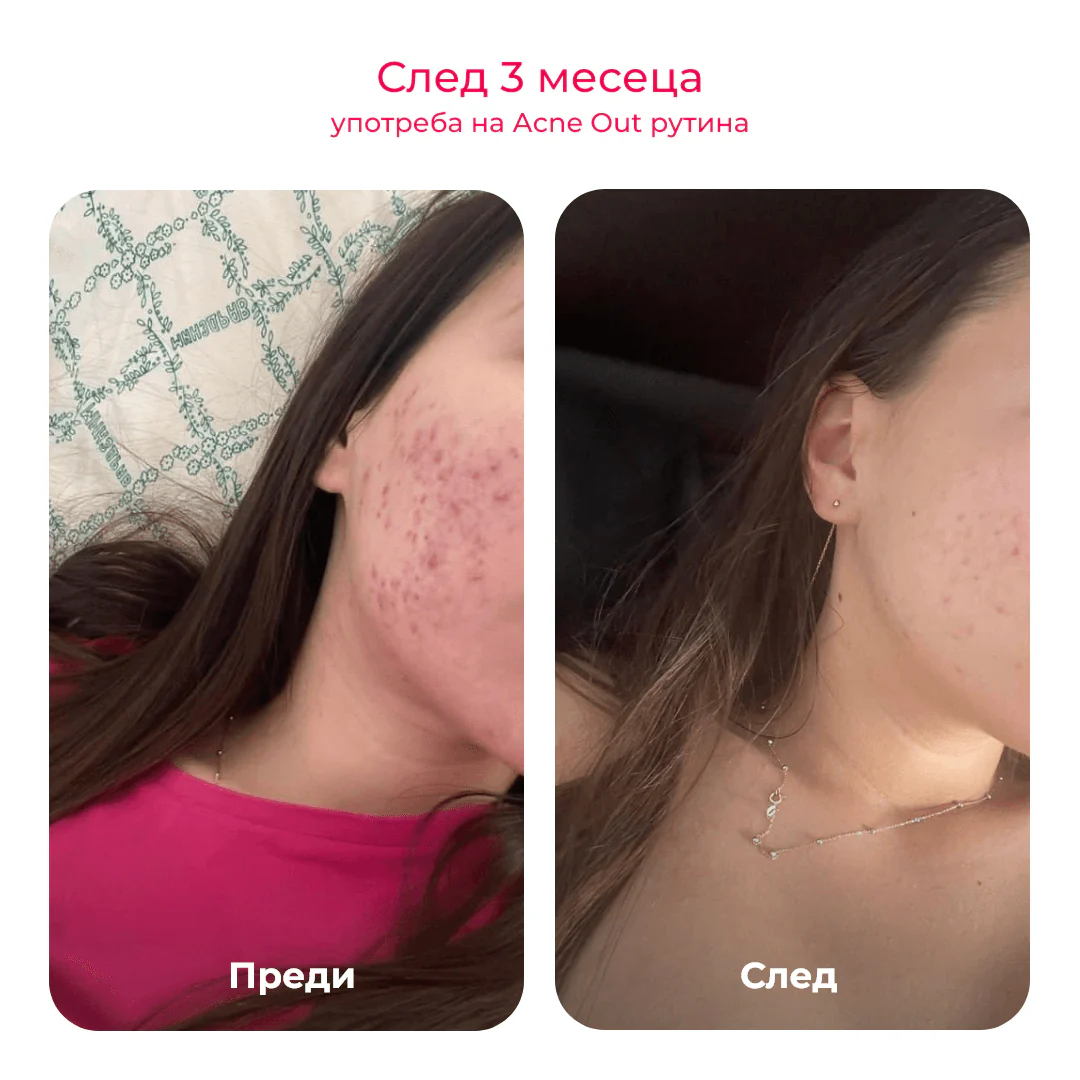 Acne Out активен лосион против пъпки, 60 мл - Image 8