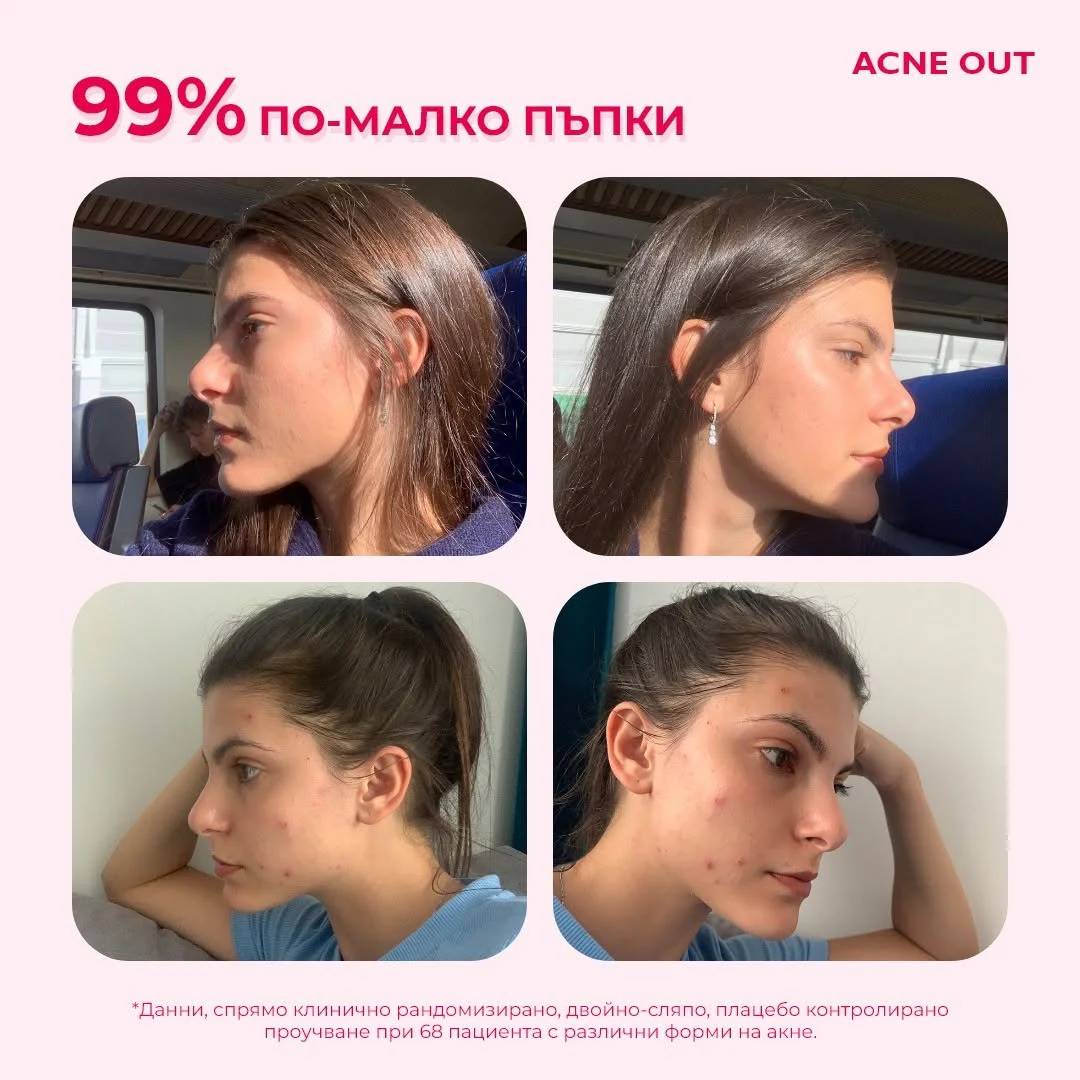 Acne Out активен лосион против пъпки, 60 мл - Image 5