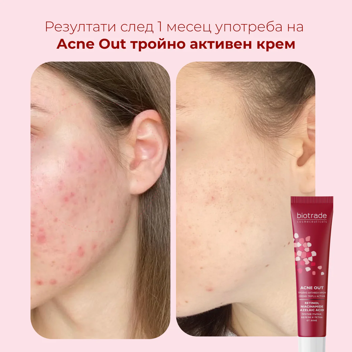 Acne Out тройно активен крем с Ретинол, Азелаинова киселина и Ниацинамид против пъпки и белези от акне, 30 мл - Image 4