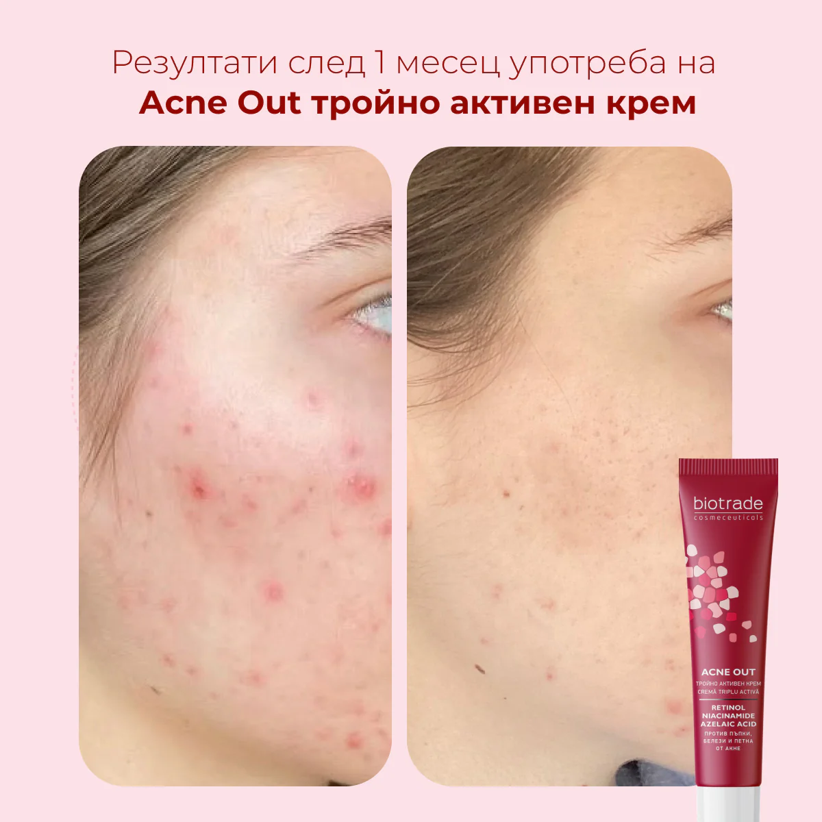 Acne Out тройно активен крем с Ретинол, Азелаинова киселина и Ниацинамид против пъпки и белези от акне, 30 мл - Image 5